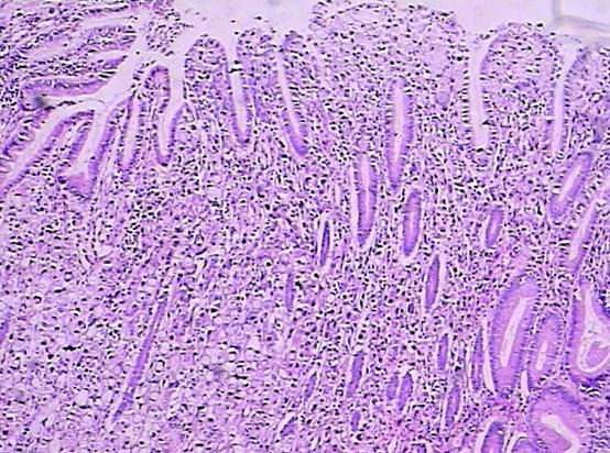 图十三,胃壁粘膜,右侧呈不典型增生,左侧部癌变,见印戒细胞.